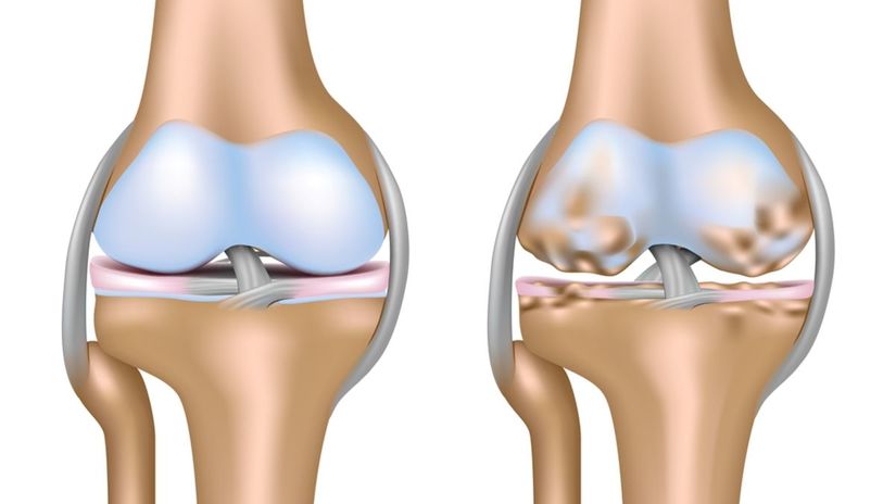 osteoartroza kolena)