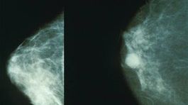 S odhaľovaním rakoviny pomôžu aj zubári