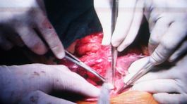 Siamské dvojičky boj o život prehrali