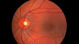 Keď "ochorie" žltá škvrna