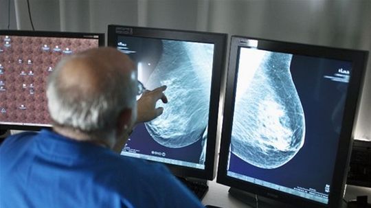 mamograf, rakovina prsníka, prsník