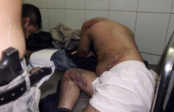 November 2005. Iračan ukazuje v nemocnici rany,...