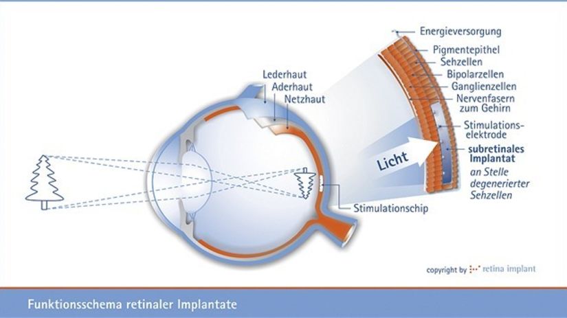 implantát v oku