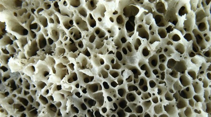 kosť, osteoporóza
