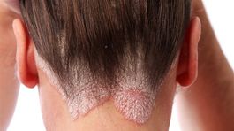 Máte psoriázu? Ako na ňu?