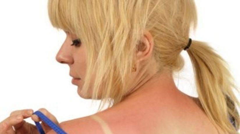 Anketa: Ako zvládate alergiu na slnko?