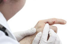 Popáleniny sa chladia iba vodou, babské rady nepomôžu