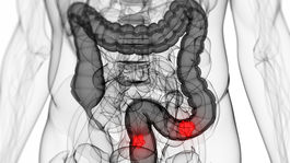 Rakovina hrubého čreva: Nečakajte na prvé príznaky