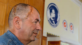 Lekári voperovali pacientovi do lebky unikátny slovenský implantát