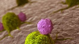 Čo čaká pacienta pri vyšetrení a diagnostike lymfómu