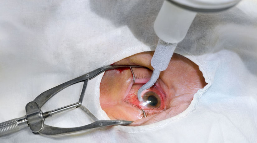 oko, šošovka, operácia očí, chirurgia,...