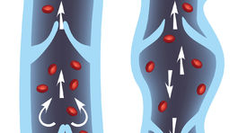 Ako vzniká chronické žilové ochorenie