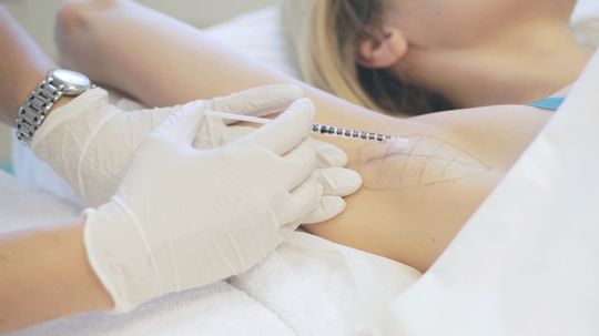 Problém s potením? Vyrieši ho botulotoxín. 