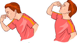 Pri krvácaní z nosa nezakláňajte hlavu. Robte pravý opak