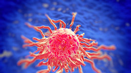 Metastatický karcinóm pankreasu je zúfalstvom. Päť rokov prežijú len dve percentá