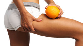 Zbavte sa celulitídy navždy. S týmito tipmi