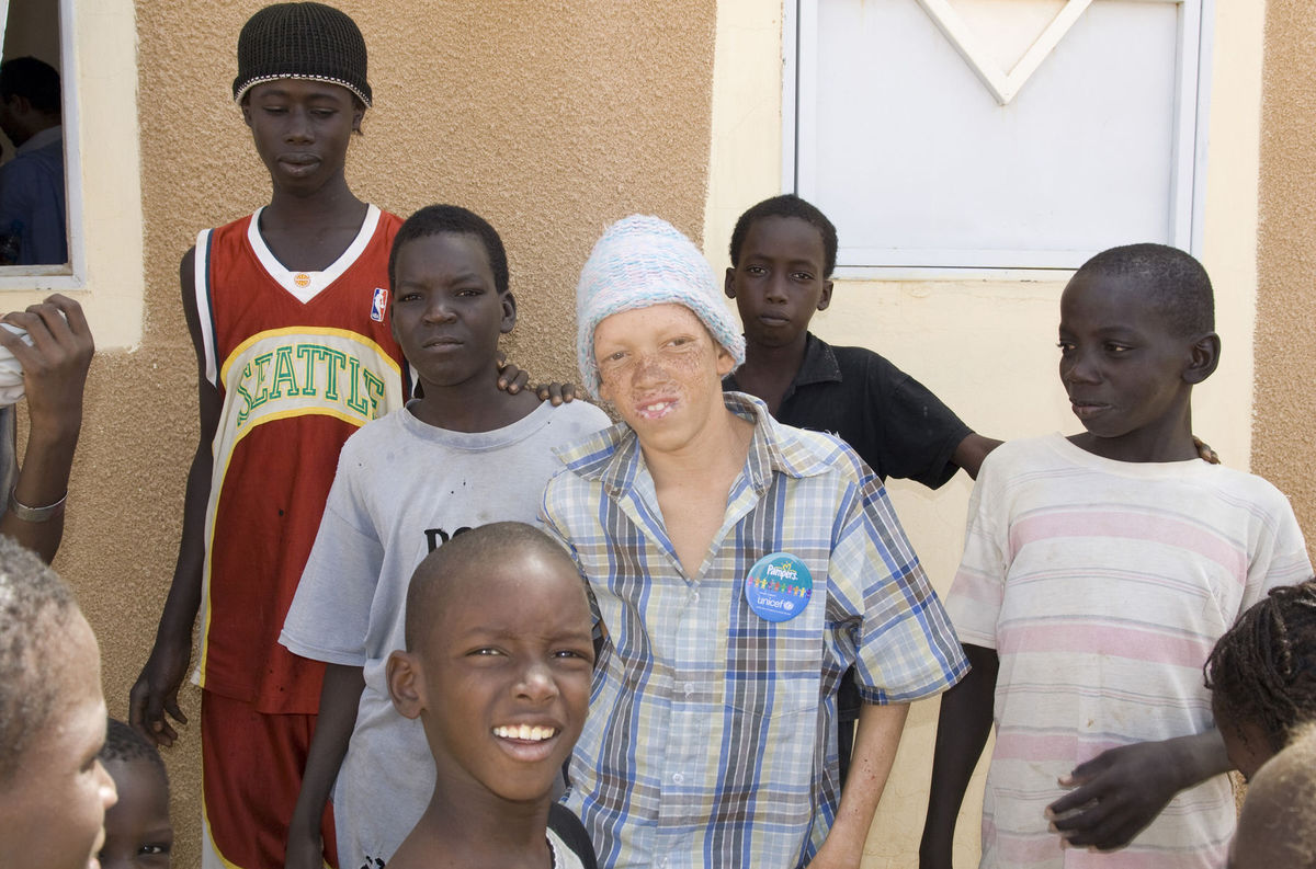 Albínsky chlapec Babdžuk v africkej Mauretánii.