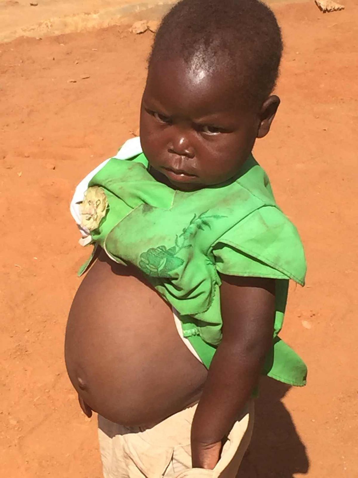 Podvyživené dievčatko má opuchnutú tvár a veľké...