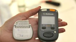 Nový neurostimulátor zlepšuje liečbu parkinsona