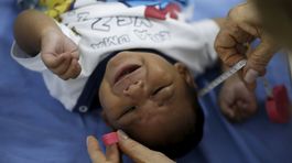 V Brazílii zaznamenali 4 120 podozrivých prípadov mikrocefálie