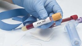 Aj vysoká sexuálna aktivita a promiskuita môže mať vplyv na vznik rakoviny prostaty