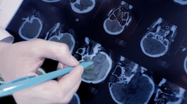 Protónová liečba má menej vedľajších účinkov