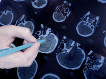  Viete, aké sú príznaky nádoru na mozgu?...