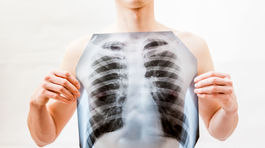 Umelá inteligencia sa osvedčila pri diagnostike rakoviny pľúc