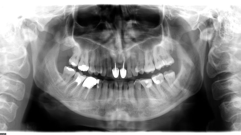 rontgen, rtg, zubár, zuby, implantát