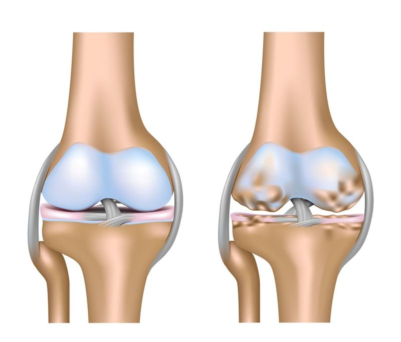 artroza a strava umflarea ligamentelor genunchiului
