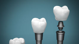 Dentálny implantát.