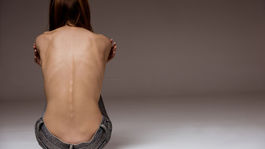 Anorexia ako módny výstrelok? Čo si o poruchách príjmu potravy myslia Slováci?