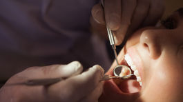 Zubný kaz je infekčné ochorenie