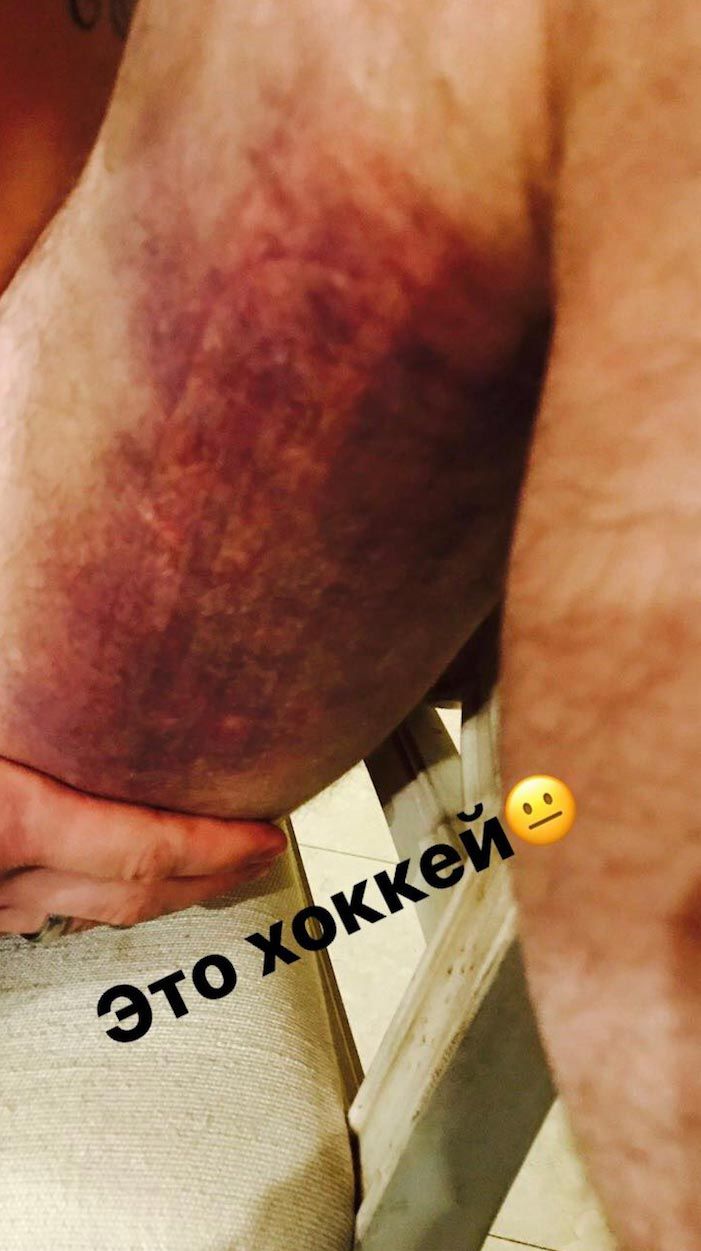 Zranené stehno Alexandra Ovečkina.