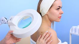 Melanóm: Sledujte svoju kožu