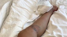 Vlhová uverejnila fotografiu zranenej nohy. Aj dôkaz, že nespadla z motorky