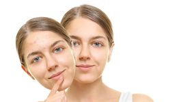 Vyrážky na brade? Čo ich môže spôsobovať práve vám? 