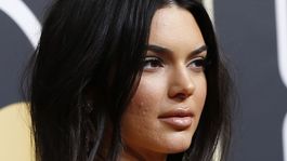 Silné akné ju nezastaví! Najlepšie platená modelka sveta žiarila aj s ním