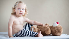 Osýpky nie sú banálnym detským ochorením