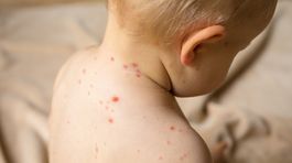 Epidémia osýpok na dolnom Zemplíne neustupuje, chorých pribudlo