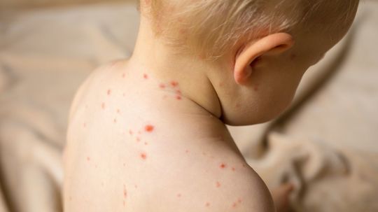 Ako sa šíria a je očkovanie účinné? Osýpky sú pre deti nebezpečné. Ide o závažne a veľmi nákazlivé ochorenie