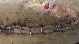 Len pre cyklistov a silné povahy. Španiel Sánchez ukázal svoje zranenie z Tour