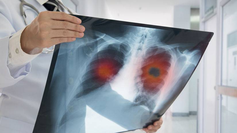 pľúca, rakovina, Röntgen, Röntgenová snímka