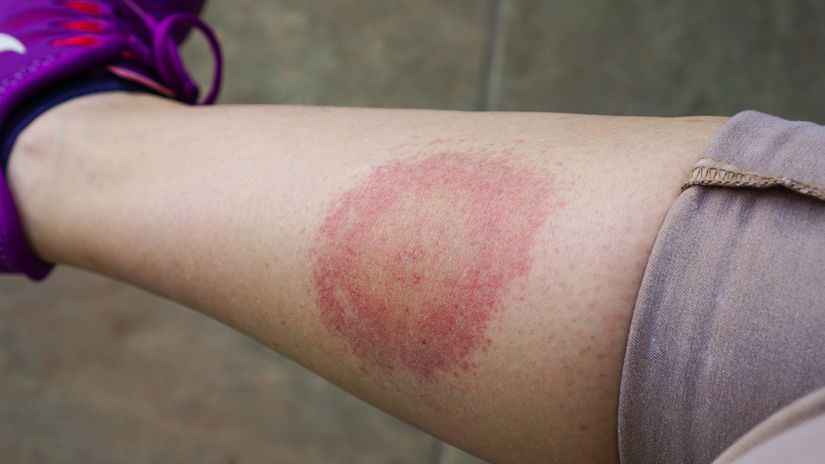 Lymská borelióza - príznak na pokožke niekoľko...