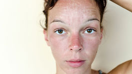 Ako na pokožku s akné v horúcom lete? Stavte na účinnosť a šetrnú opateru