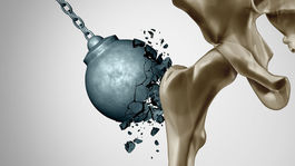 Osteoporóza: Láme kosti a kradne roky života