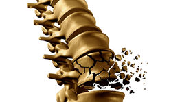 Osteoporóza - hrozba pre pohybový aparát