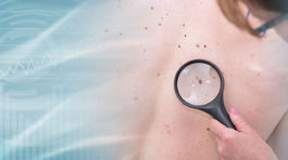 Je svetlý melanóm menej zhubný a tmavý zabíja? Mýty a fakty