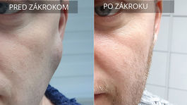 Máte na tele hrču? Ukážte ju lekárovi