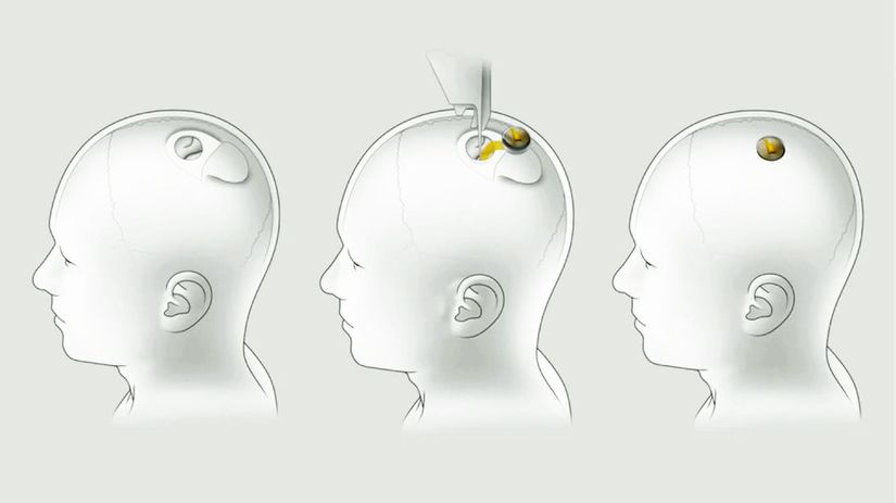 Neuralink, mikročip, implantát